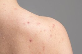 scar revision surgery in bangalore